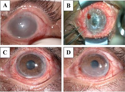 Case report: Two-step lamellar keratoplasty for alkali burns